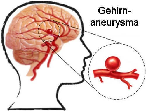 Intrakranielles Aneurysma