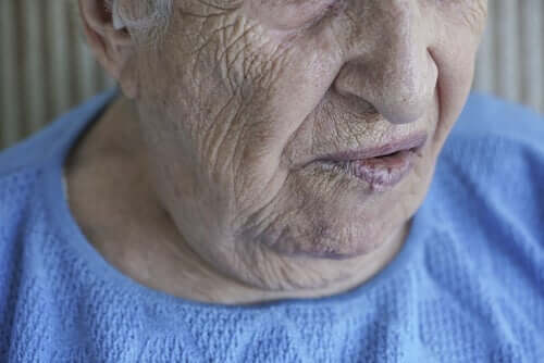 Gesichtslähmung: Ursachen und Behandlung