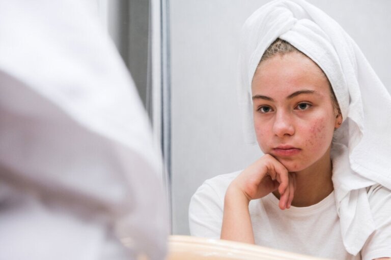 Die psychologischen Auswirkungen von Akne bei Jugendlichen